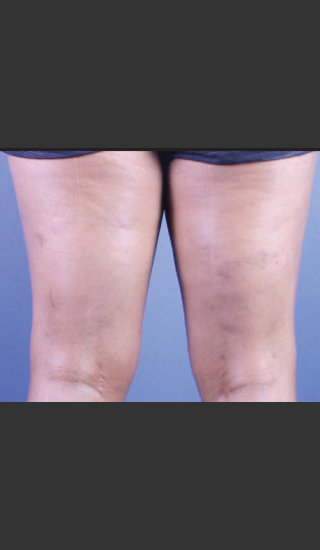 After Photo for Sclerotherapy Treatment for Varicose Veins - Daniel Friedmann  - Prejuvenation