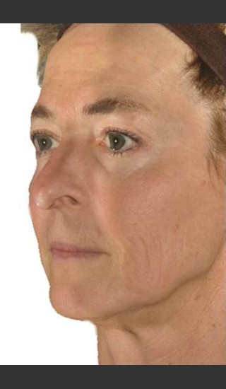 After Photo for Infini Facial Laxity and Rhytides Treatment -  - Prejuvenation