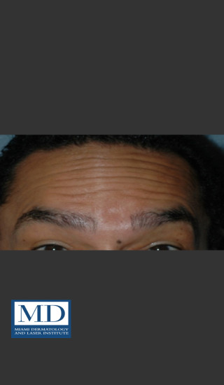 Before Photo for Neurotoxin Treatment of Forehead 131 - Jill S. Waibel, MD - Prejuvenation