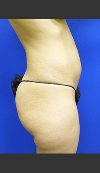 Before Photo for Brazilian Butt Lift Case #1 - Paul C. Dillon, MD - Prejuvenation