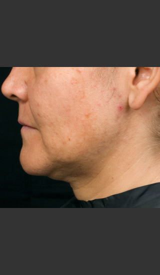 Before Photo for Thermage Procedure Before and After I -  - Prejuvenation