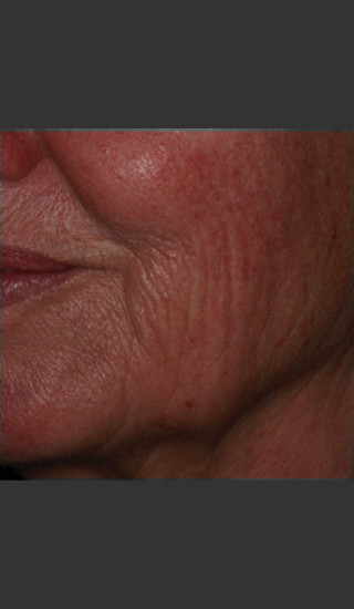 Before Photo for Infini Rhytides Treatment #19 -  - Prejuvenation
