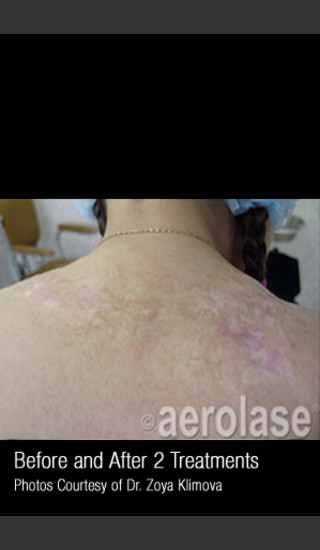 After Photo for Treatment of a Juvenile Burn Scar #343 -  - Prejuvenation
