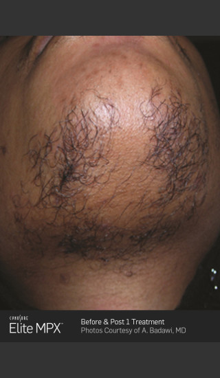 Before Photo for Hair Removal on Chin with Elite MPX -  - Prejuvenation
