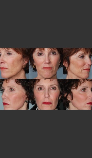 After Photo for Single treatment of fully ablative  Laser Resurfacing - Mark B. Taylor, M.D. - Prejuvenation