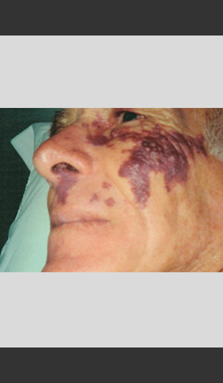 Before Photo for Vbeam Laser Treatment of Port Wine Stain -  - Prejuvenation