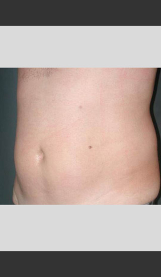 After Photo for UltraShape Body Contouring Abdomen -  - Prejuvenation