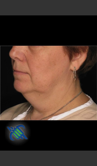Before Photo for Laser Liposuction of Lower Face - Roy G. Geronemus, M.D. - Prejuvenation