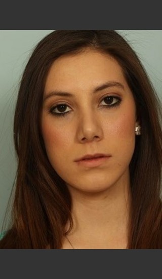 After Photo for Rhinoplasty Surgery - El Paso Cosmetic Surgery - Prejuvenation