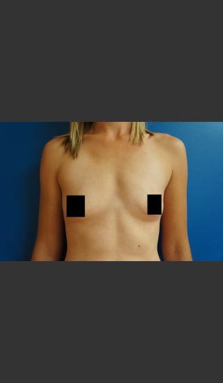 Before Photo for Breast Augmentation - Dr. Josh Olson - Prejuvenation