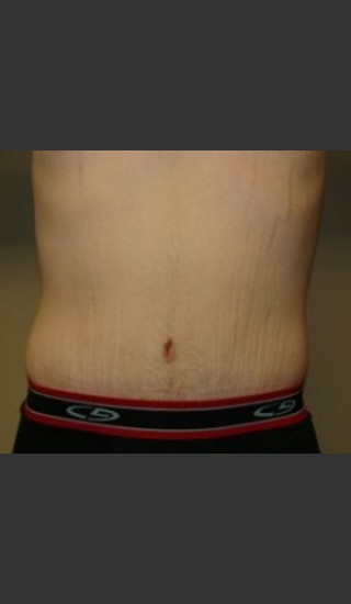 After Photo for Belt Lipectomy 7986 - Sanjay Grover MD FACS - Prejuvenation