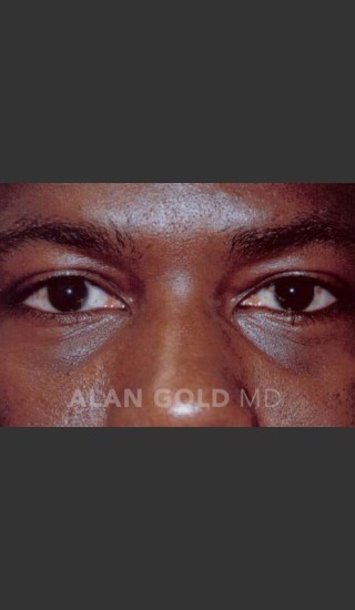 After Photo for Blepharoplasty 1027 - Alan Gold MD - Prejuvenation