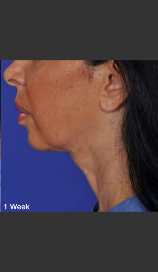 After Photo for ThermiTight Treatment - Barry E. DiBernardo, MD, FACS - Prejuvenation