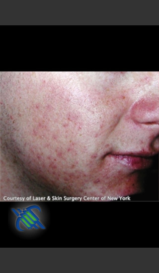 Before Photo for Treatment of Facial  Acne Scars - Roy G. Geronemus, M.D. - Prejuvenation