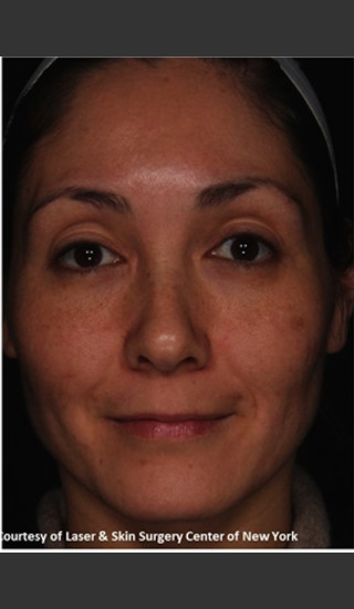 After Photo for Treatment of Melasma -  - Prejuvenation