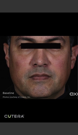 Before Photo for Skin Revitalization of Male Face Before & After Photo -  - Prejuvenation