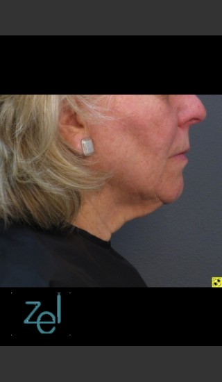 After Photo for Treatment of Lower Face with Ultherapy - Brian D. Zelickson, M.D. - Prejuvenation