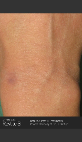 After Photo for Revlite SI laser Tattoo Removal -  - Prejuvenation