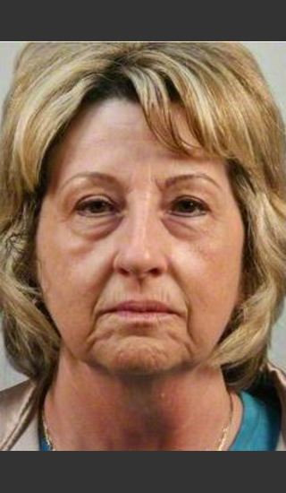 Before Photo for 61 year old woman treated with Facelift - R. Scott Yarish MD, FACS - Prejuvenation