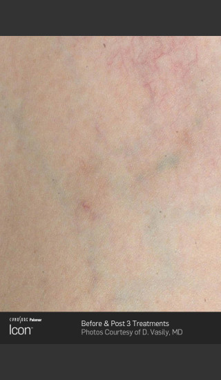 After Photo for Leg Vein Clearance Using Icon -  - Prejuvenation