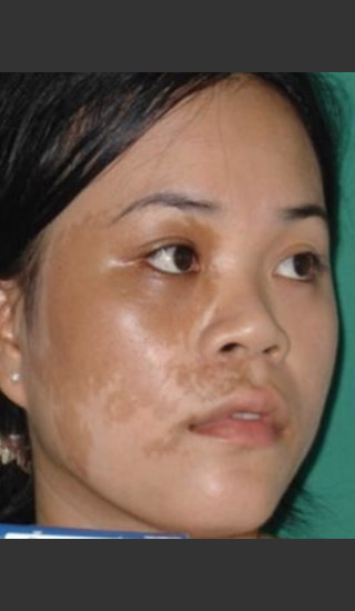 Before Photo for Quanta MDK Treatment of Pigment #78 -  - Prejuvenation