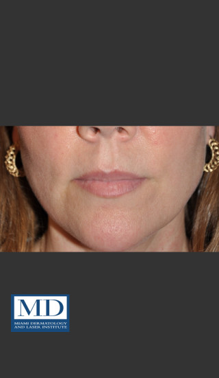 Before Photo for Lip Filler 135 - Jill S. Waibel, MD - Prejuvenation