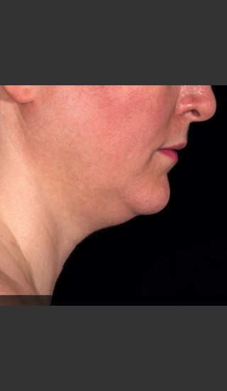 After Photo for SculpSure Submental - Bruce E Katz, M.D. - Prejuvenation