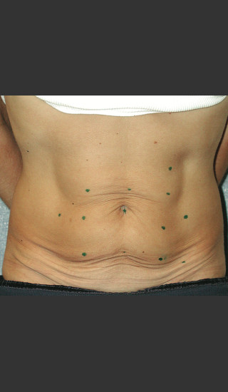 Before Photo for Thermage Procedure Before and After III -  - Prejuvenation