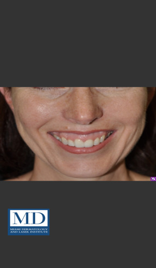Before Photo for Neurotoxin Gummy Smile 128 - Jill S. Waibel, MD - Prejuvenation