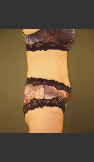 After Photo for Liposuction #44 Side View - Dr. David Amron - Prejuvenation
