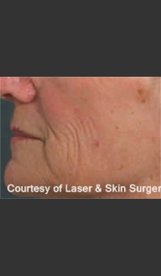 Before Photo for Treatment of Fine lines and Wrinkles -  - Prejuvenation