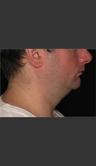 Before Photo for Treatment of Neck Contour -  - Prejuvenation