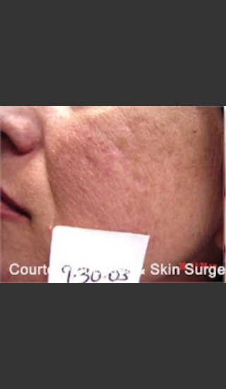 Before Photo for Treatment of Facial  Acne Scarring -  - Prejuvenation