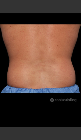 Before Photo for CoolSculpting Before & After on Man -  - Prejuvenation