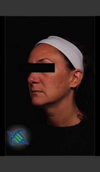Before Photo for Treatment of Facial Melasma - Roy G. Geronemus, M.D. - Prejuvenation