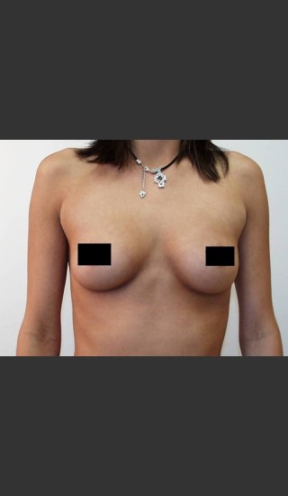 Before Photo for Breast Augmentation - Braden C. Stridde, M.D. - Prejuvenation