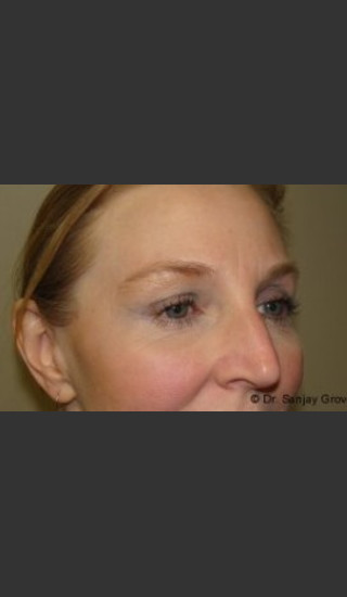 After Photo for Blepharoplasty 6307 - Sanjay Grover MD FACS - Prejuvenation