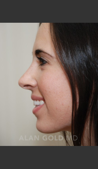 After Photo for Rhinoplasty 1669 Side View - Alan Gold MD - Prejuvenation