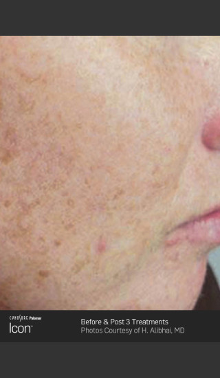 Before Photo for Skin Revitalization Before & After Photo -  - Prejuvenation