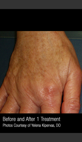After Photo for Treatment of Pigmentation #329 -  - Prejuvenation