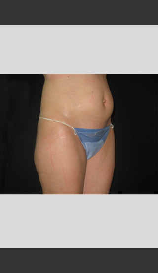 Before Photo for Fat Cell Destruction Body Contouring -  - Prejuvenation