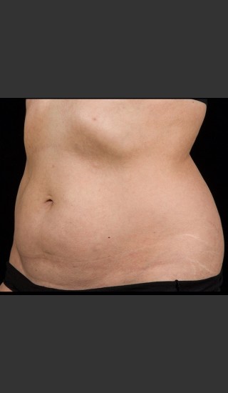 After Photo for SculpSure Abdomen - Lawrence Bass MD - Prejuvenation