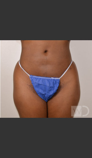 After Photo for SmartLipo Liposuction of Outer Thighs - Chuma Chike-Obi MD - Prejuvenation