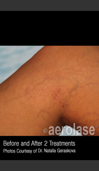 Before Photo for Treatment of Leg Veins #316 -  - Prejuvenation