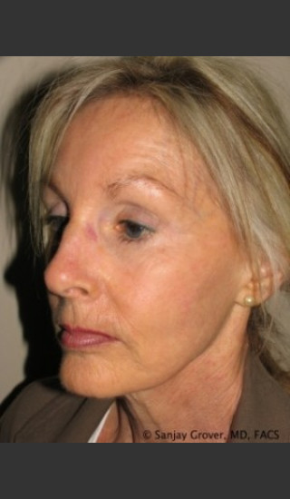 Before Photo for Facelift Case 6944 - Sanjay Grover MD FACS - Prejuvenation