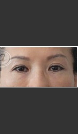 After Photo for Undereye Filler - Annie Chiu, MD - Prejuvenation