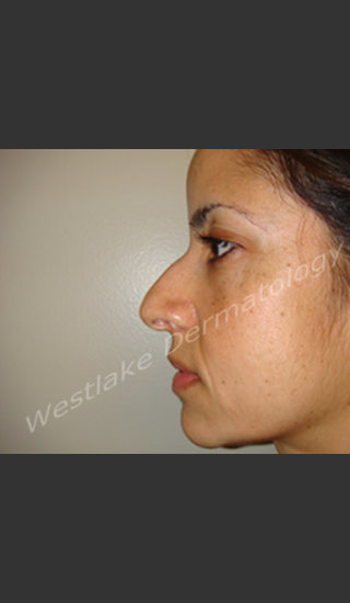 Before Photo for Rhinoplasty Treatment of Female Patient - Cameron Craven MD FACS - Prejuvenation