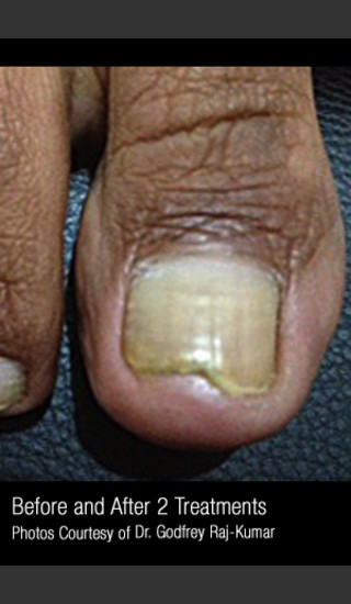 After Photo for Treatment of Nail Fungus #321 -  - Prejuvenation