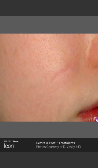 After Photo for Scar Reduction Before & After Photo -  - Prejuvenation