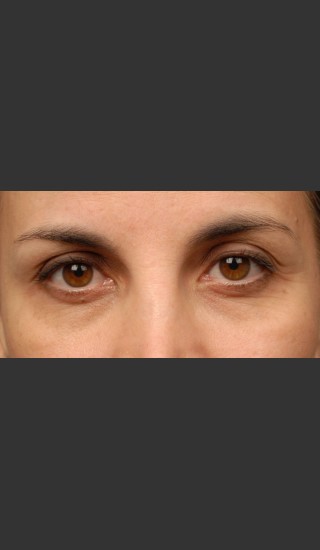 After Photo for 3DEEP Eye Wrinkle Reduction -  - Prejuvenation